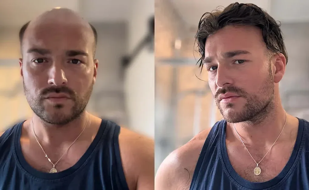 Hair system for men natural look before and after