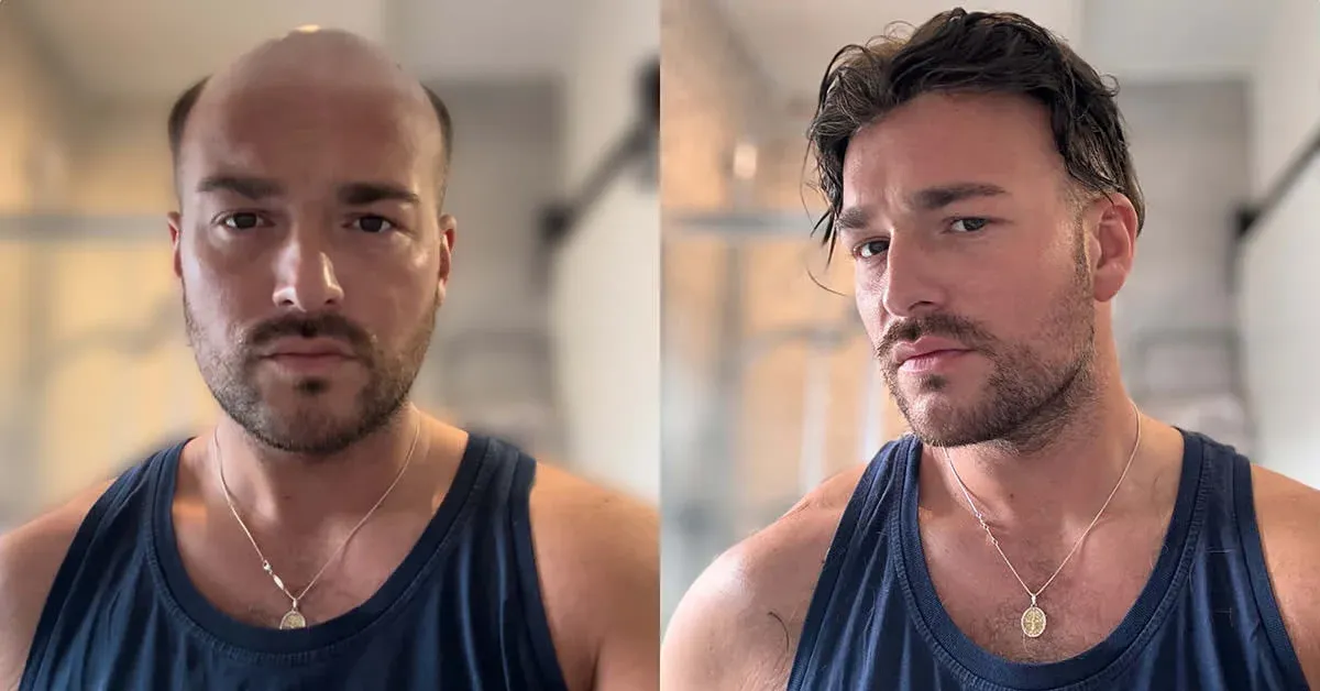 Hair system for men natural look before and after